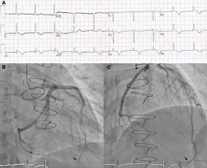 A) Electrocardiograma. B y C) Coronariografía: flecha negra: imagen de embolismo en segmento muy distal de arteria coronaria descendente anterior.