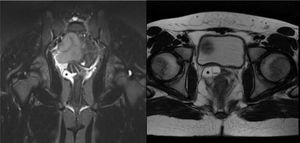 RMN: Colección mucosa (*) en hemivagina que oculta un cérvix (corte coronal y transversal).