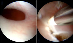 Orificio puntiforme en tabique vaginal con posterior resección histeroscópica de tabique liberando hemivagina y cérvix oculto.