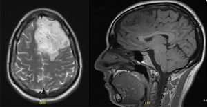 (Caso 1) RM R1 y T2: Lesión intraaxial corticosubcortical frontal izquierda sugestiva de astrocitoma acompañada de edema perilesional y desplazamiento de la línea media.