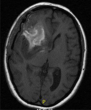 (Caso 2) RM T1 Lesión en zona insular derecha con edema perilesional que sugiere astrocitoma.