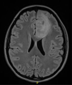 (Caso 3) RM T1: Tumoración corticosubcortical frontal izquierda con mínimo desplazamiento de la media y edema perilesional que sugiere astrocitoma difuso vs. anaplásico vs. oligodendroglioma.