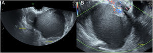(A) Transvaginal ultrasound showing a right ovary with a 24mm×17mm unilocular cystic image indicative of an endometriotic cyst. The left ovary is occupied by a formation of 83mm×77mm×73mm with irregular border, ground glass content and a solid portion at the upper pole. (B) Transvaginal ultrasound: central vascular flow (SCORE 3) in the solid portion of the cyst.