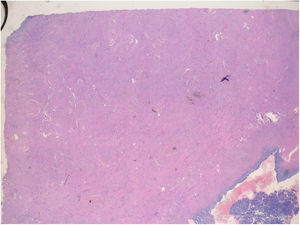 Hematoxylin–eosin (H&E) staining: The seromucinous tumor invasion front is observed at the bottom right, covering the uterine serosa and the external thrid of myometrium.