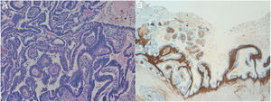 (A) H&E staining, magnification ×100: Serous and mucinous components (upper right end: rows of epithelial cells with cytoplasm occupied by a big vacuola). (B) Inmunohitochemistry: positive for CD10, evidencing the presence of endometrial stroma inside the neoplasm.