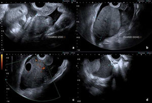 Ecografía pélvica transvaginal. a: ovario izquierdo; b: ovario derecho; c: captación doppler de predominio central; d: implante peritoneal en fondo de saco de Douglas.