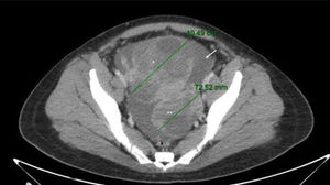 TAC con contraste IV de abdomen y pelvis. En zona anexial derecha se observa masa compleja (*) de 104mm de máximo diámetro, y en zona anexial izquierda imagen de similares características (**) de 73mm de máximo diámetro. Abundante líquido ascítico en abdomen y pelvis (flecha).