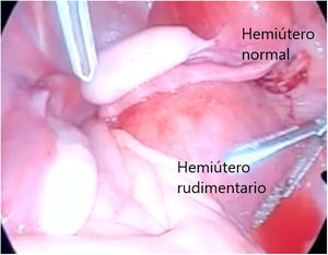 Hemihisterectomía laparoscópica.