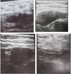 Ecografía de abdomen. Imágenes hipogénicas ovaladas de contornos definidos con circulación central a nivel de fosa iliaca derecha y extremo derecho de cicatriz.