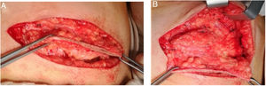 A) Resección de la cicatriz quirúrgica. B) Talla de colgajos, se eleva piel y grasa y abajo endometriosis.