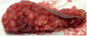 Pieza quirúrgica. Tejido celular subcutáneo, nódulos producidos por la endometriosis y compromiso de fascia.