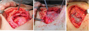 A) Defecto después de la escisión de la endometriosis que llega hasta el peritoneo, a los lados se parecían músculo recto anterior del abdomen y oblicuo externo. B) Colocación de malla profunda preperitoneal. C) Colocación de malla superficial adherida a la fascia del oblicuo externo.
