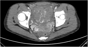 Imagen de TAC en la que se observa un útero agrandado de tamaño y con aumento de la vascularización.