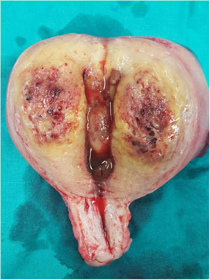 Pieza quirúrgica de histerectomía en la que se observa macroscópicamente la infiltración del miometrio por el TTLP.
