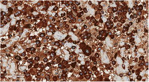 Expresión de hPL a nivel citoplasmático en las células neoplásicas (hPL,×200).