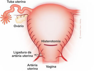 Ligation of the uterine arteries. Anterior view. Illustration by Felipe Lage Starling (authorized).