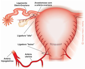 Ligation of the uterine arteries and the uterine-ovarian connections. Anterior view. Illustration by Felipe Lage Starling (authorized).