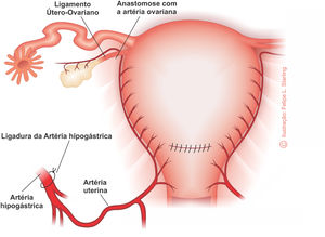 Ligation of the internal iliac arteries. Anterior view. Illustration by Felipe Lage Starling (authorized).
