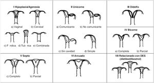 Imagen esquemática de la Clasificación clásica de malformaciones uterinas congénitas publicada en 1988 por la AFS, actualmente ASRM2.