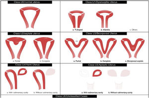 Imagen esquemática de la Clasificación de malformaciones uterinas congénitas CONUTA publicada conjuntamente por ESHRE y ESGE1,11.