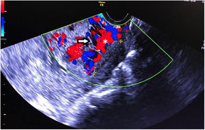 Ecografía transvaginal que demuestra placenta previa oclusiva total con la presencia de múltiples lagunas vasculares (flecha en blanco) y flujo aumentado al Doppler color.