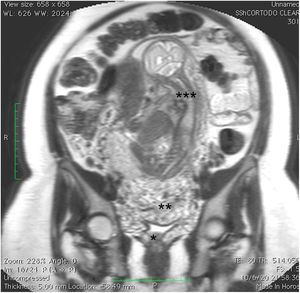 Resonancia magnética nuclear: se demuestra la presencia de placenta previa, con lagunas vasculares y pérdida de la interfaz miometrial, con invasión cervical. * cérvix; ** placenta previa oclusiva total; *** feto.