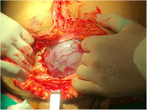 Incisión en línea media. Se muestra la vascularidad anormal del segmento uterino.