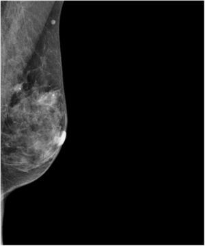 Mamografía, proyección OML. Se objetivan dos nódulos retroareolares BIRADS4.