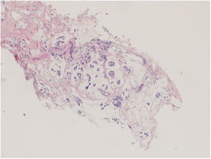 Cilindro BAG, nódulo antes de quimioterapia neoadyuvante (QNA). 4×, tinción de Gram.