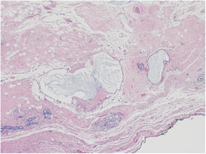 Pieza quirúrgica de mastectomía tras quimioterapia neoadyuvante (QNA). Nótese la reducción del componente epitelial. 10×, tinción de Gram.