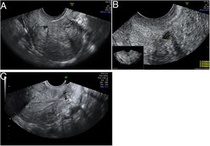 Istmocele en el momento del diagnóstico (A, B) y tras la reparación por histeroscopia (C).