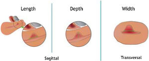 Mediciones básicas de un istmocele: longitud y profundidad se deben tomar en un plano sagital, y el grosor en un plano transverso. Imagen adaptada de Jordans et al.5.