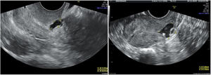 Tipos de istmoceles. A)Istmocele simple. B)Istmocele simple con una rama. También hay casos de istmoceles complejos con varias ramas.