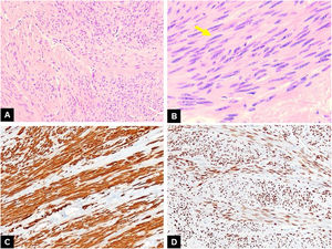 Estudio anatomopatológico: Leiomioma ovárico. A) A poco aumento, vemos un tumor formado por una intersección de fascículos, compuesto por células con cierta tendencia a la formación de «empalizada nuclear» y con áreas fibrosas, sin observarse zonas de necrosis ni hemorragia (HE, 10×). B) A mayor aumento, observamos con detalle las características de la población celular: células fusiformes con citoplasma eosinófilo, núcleos en «forma de cigarro» (flecha) con cromatina fina y pequeño nucléolo sin atipia. Además, no observamos figuras de mitosis (HE, 20×). C) Expresión intensa y generalizada para desmina, marcador de músculo liso (desmina, 10×). D) Por último, en esta imagen observamos expresión intensa y generalizada de receptores de estrógenos (RE) (RE, 10×).