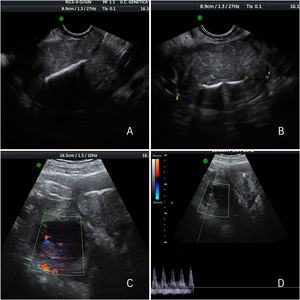 Imágenes de ecografía transvaginal y transabdominal en las que se observa un corte longitudinal A) y transversal B) del útero con DIU normoinserto y ausencia de gestación intrauterina, y una masa ovárica derecha C) compatible con embarazo ectópico ovárico con gestación evolutiva D). El examen en tiempo real mostró que el saco gestacional y el ovario no se podían separar al mover la sonda transvaginal, lo que era diagnóstico de embarazo ectópico intraovárico.