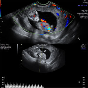 Imágenes de la ecografía transvaginal en las que se observa el ovario derecho, con un anillo externo hiperecogénico y captación Doppler periférica y un saco gestacional intraovárico A) con feto en su interior con actividad cardíaca presente B).