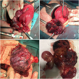 Imágenes de la cirugía en las que se observa salida incidental del feto del interior del ovario derecho al realizar adhesiólisis de la masa ovárica A), que se encuentra unida al útero por el ligamento útero ovárico A, B). En C) y D) se muestra la imagen macroscópica de feto y placenta, esta última implantada en la cara interna del ovario derecho.