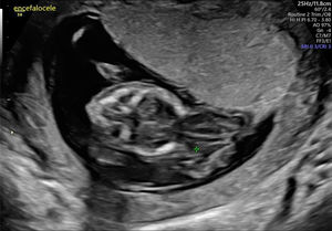 Se observa un encefalocele occipital de gran tamaño, con defecto a nivel posterior de la calota y herniación de las estructuras cerebrales.