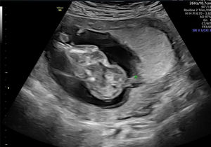 Se señala la presencia de una banda amniótica en la parte más posterior del encefalocele (cruz verde), conectada al amnios.