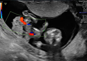 En el corte realizado se visualiza defecto de la pared abdominal anterior, con gastrosquisis y herniación de gran cantidad de asas de intestino delgado.