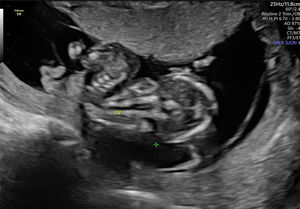 Se presenta corte coronal, en el que se visualiza una cifoescoliosis fetal severa a nivel lumbar. Se visualiza otra banda amniótica en la parte inferior de la imagen.
