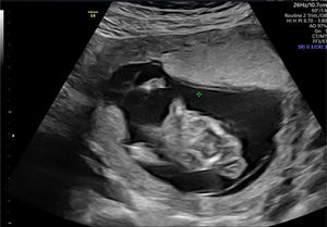 Corte a nivel de placenta y amnios, en el que se visualiza defecto importante en la fusión del amnios con el corion.