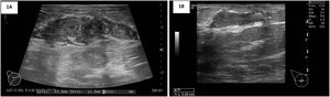 A: Ecografía mama derecha cuadrante superoexterno (CSE): área de 43×11mm asociada a una lesión nodular polilobulada, hipoecogénica y heterogénea, con márgenes irregulares. BI-RADS 4C. B: Ecografía mama derecha CSE: área hipoecogénica de unos 33mm. BI-RADS 2.
