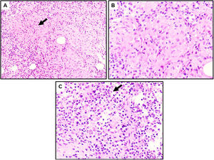 A: Granulomas no necrosantes (flecha) rodeados por un proceso inflamatorio de predominio linfoplasmocitario (HE, ×10). B: Población de macrófagos agregados que forman granulomas no caseificantes rodeados de células inflamatorias (HE, ×20). C: Abundante población de neutrófilos en un fondo de linfocitos y células plasmáticas, frecuentemente asociados a mastitis granulomatosa idiopática (HE, ×20).