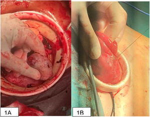 Intervención quirúrgica. A) Lesión de perforación localizada en íleon medio. B) Anastomosis previa a resección intestinal.