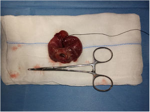 Pieza quirúrgica tras resección intestinal: lesión de perforación localizada en íleon medio.