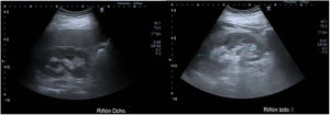 Ecografía renal bilateral a las 24h de la cirugía.