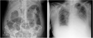 A. Íleo paralítico. B. Derrame pleural bilateral con predominio derecho.