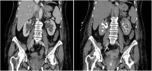 TAC de abdomen a las 96h de la cirugía.
