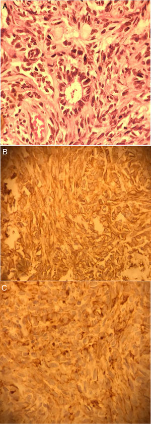 The pathology report of synovial sarcoma.